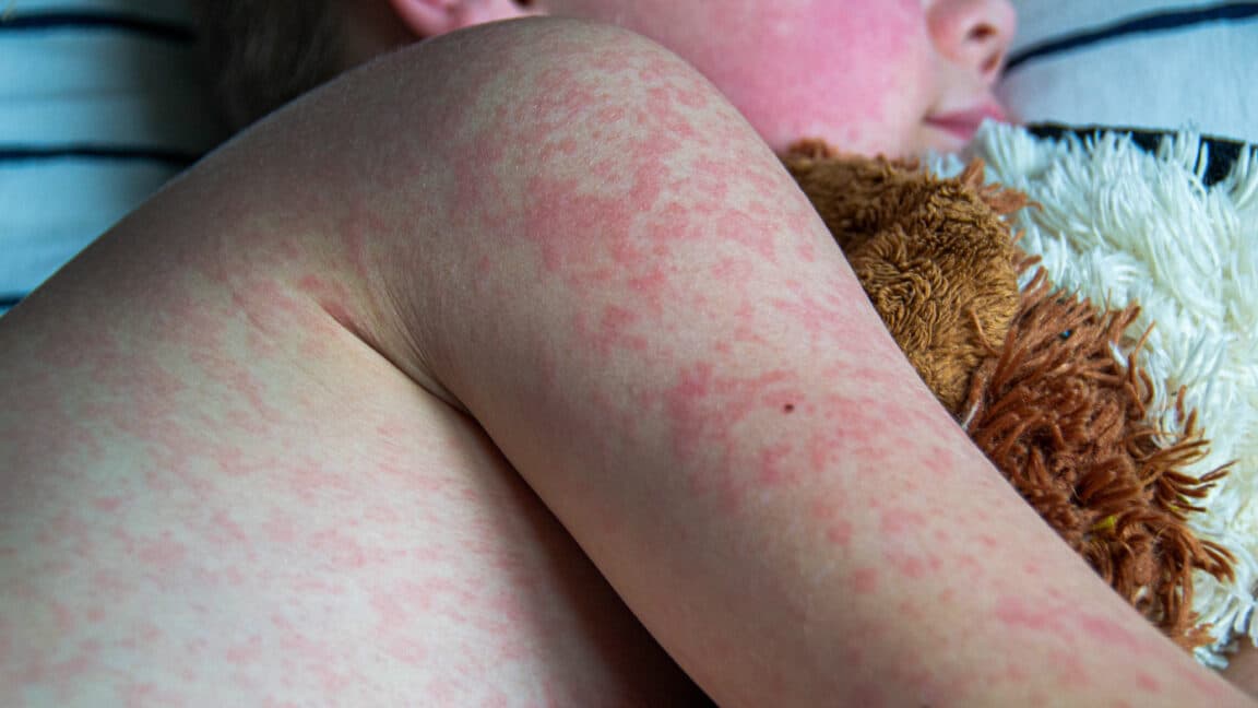 "Measles raves hit 33-year high 🎉 thanks to RFK Jr. playing anti-vax Among Us 💀 #Sus #Cope"
