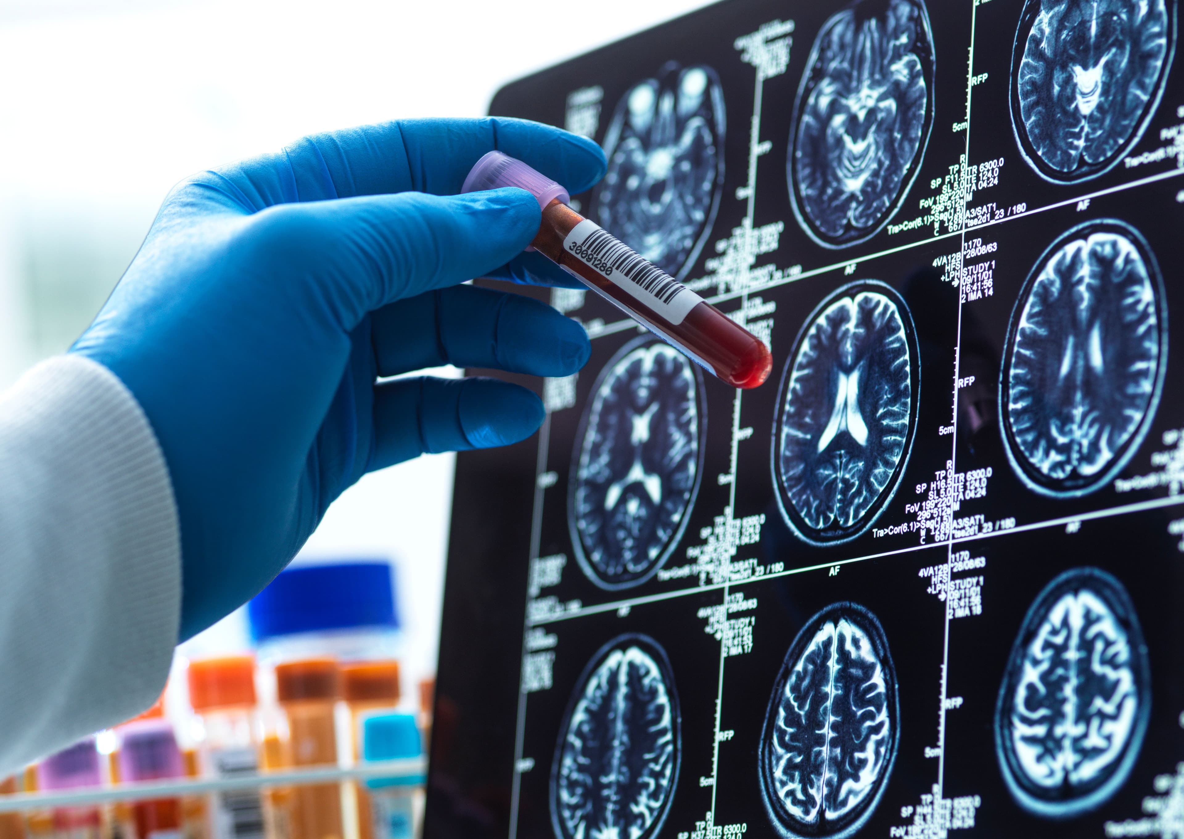 "Finally, a blood test for Alzheimer’s! 🩸💀 Time to stop forgetting where I left my keys, fr fr! 🔑🔥"